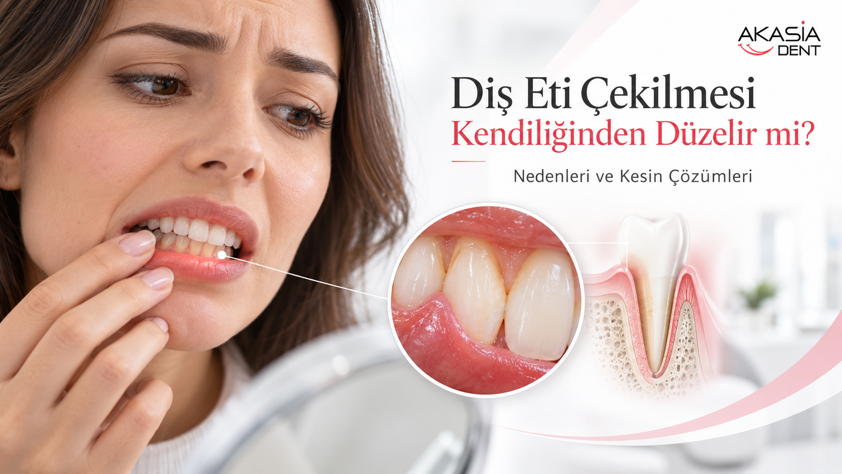 Diş Eti Çekilmesi Kendiliğinden Düzelir mi?